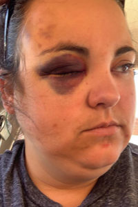 Lizzy Long is left with a painful shiner after her auto accident on April 10