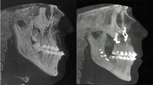 Jason Fraley's jaw x-ray