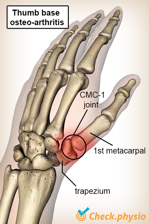 Example of arthritic thumb condition