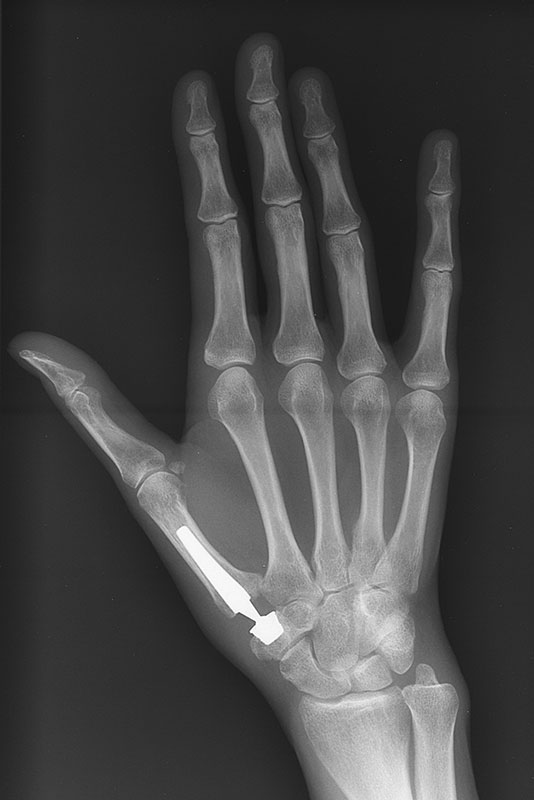 Example x-ray of a thumb replacement joint installed